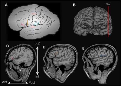 Influence of accessory sulci of the frontoparietal operculum on gray matter quantification